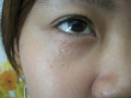 眼睛周围的脂肪粒怎么去除_眼角周围的脂肪粒怎么去除