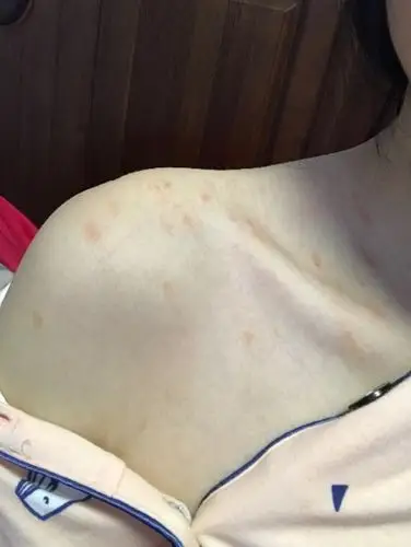 身上起红点,先是后背,然后是上半身红点点,现在腿部也出现了,不知