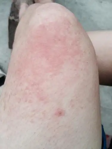 大人长湿疹是什么原因引起的