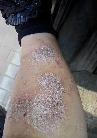 牛皮癣症状图片最初