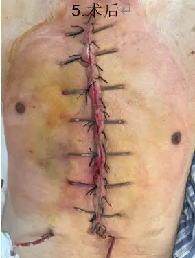 整形美容烧伤科联合eicu成功救治心脏术后胸骨切口深部感染患者