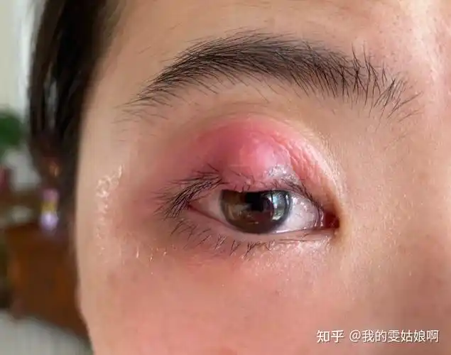 我与麦粒肿的斗争史 - 知乎