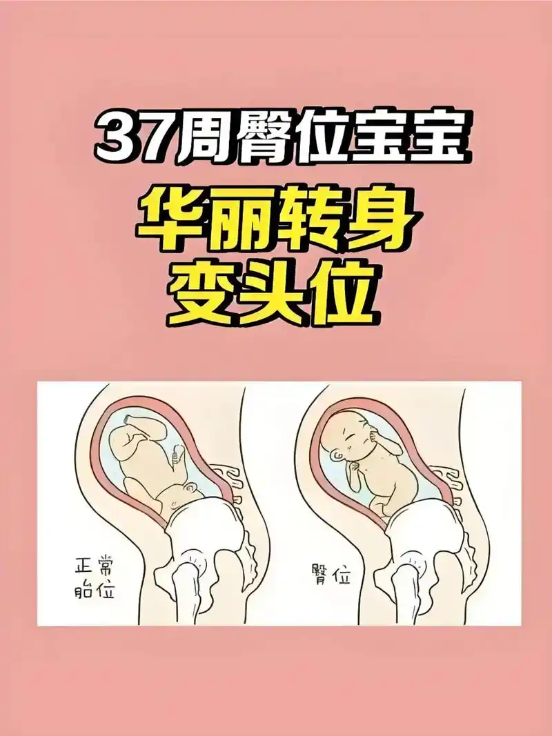 37周臀位宝宝92华丽转身93变头位6015 73很多孕妈