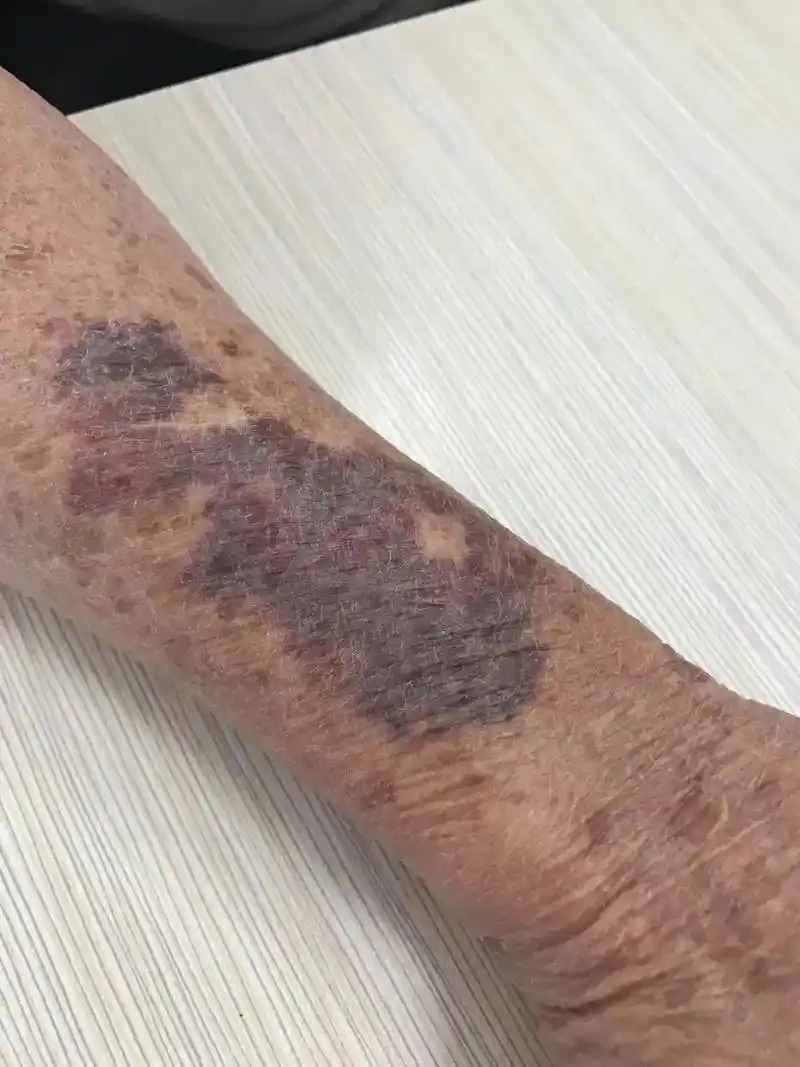 感谢爱学习的我以前不知道怎么治疗现在把这个爷爷皮肤