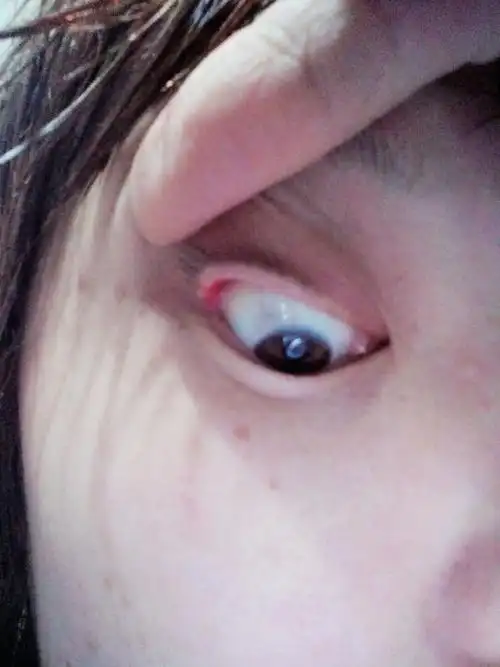 今天洗脸觉得眼角那一按就疼,结果一看眼角那长了个白色的东西,有谁