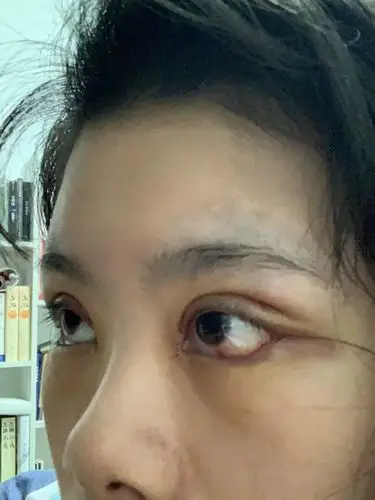 求问做过眼睑下至的妹子,我这种程度的露白,后期会回缩到正常吗?