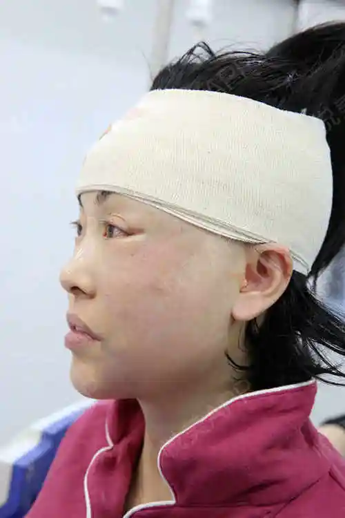 小切口手术提升术后1天_埋线提升术后1天_拉皮手术提升术后1天_紧致