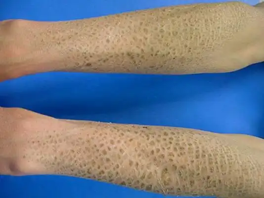 鱼鳞病初期图片 (68)