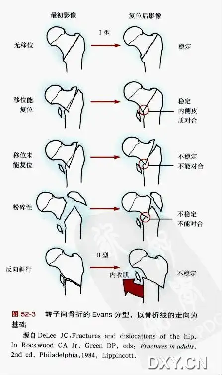 evans分型 Ⅰ型 无移位