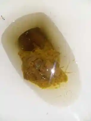 这样大便会有什么病,应该注意什么?_?