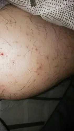 小腿上出现这样的红点是怎么回事?