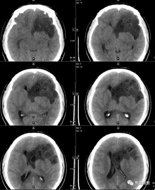 读片丨女30岁间断性头痛颅脑ctmri