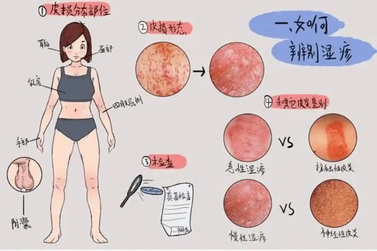 湿疹是一种常见的皮肤病,它的发病率在全球范围内都很高.