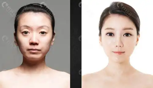 眼窝凹陷怎么恢复饱满那来看脂肪填充眼窝效果图片吧