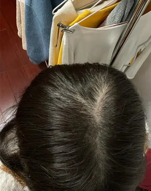 女性脱发怎么办?发量少如何变密? - 知乎