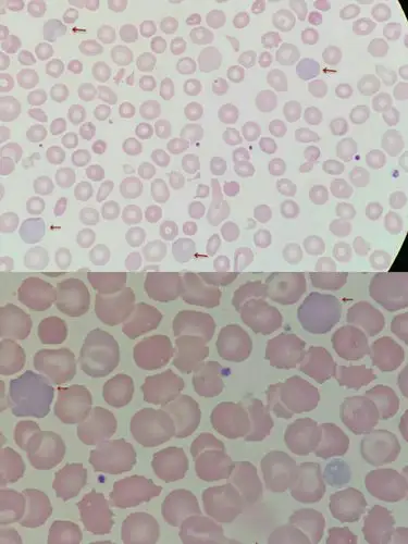 新生儿外周血嗜多色性红细胞易见,成熟红细胞大小不一,机测mcv不够准