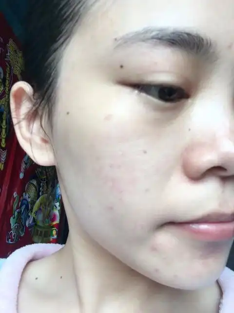 网状红血丝,估计没有人比我的更明显了