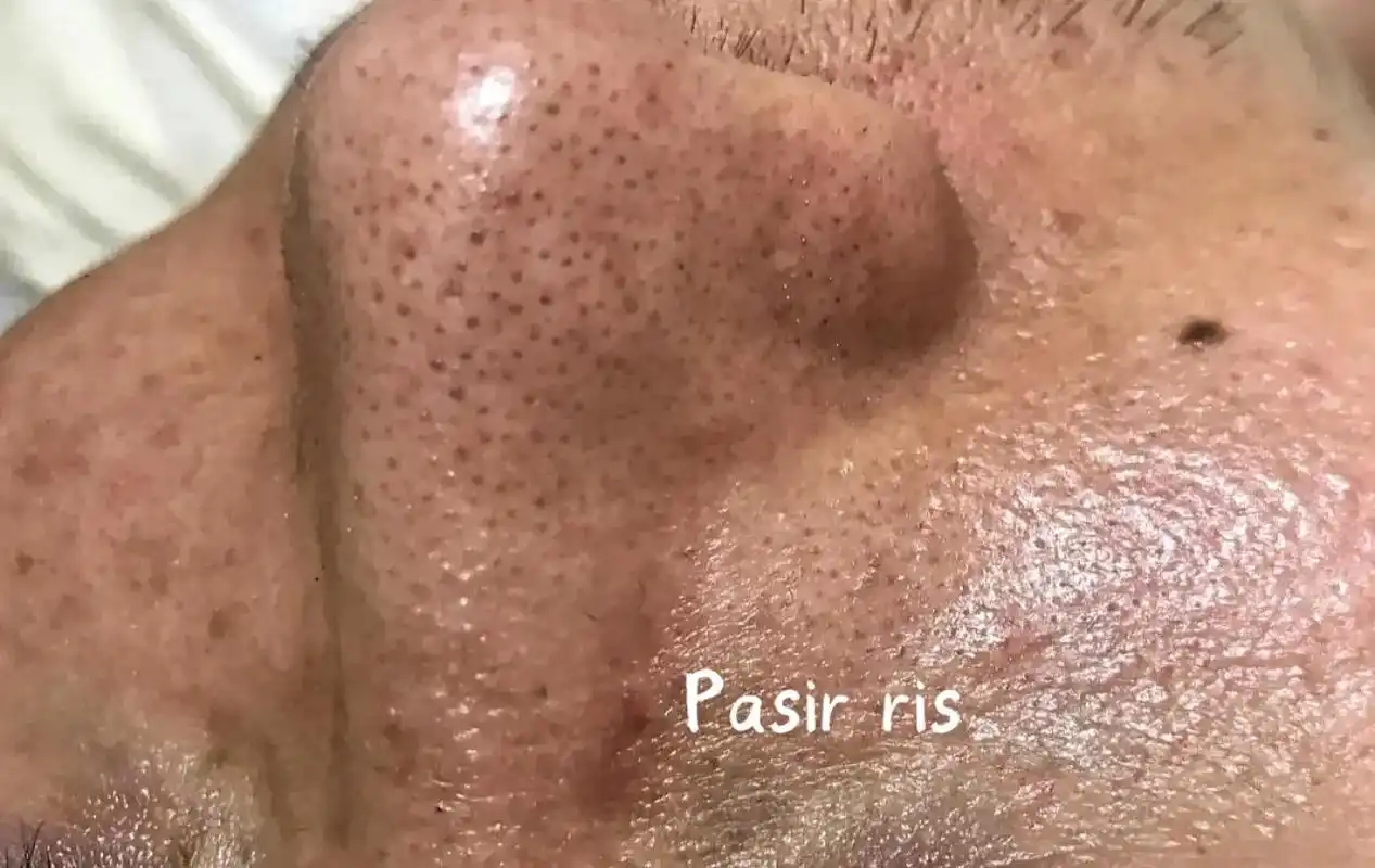 皮肤干净的重要性.深层清洁护理#黑头#针清#毛孔粗大 #新加 - 抖音