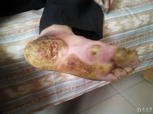 典型病例 掌趾角化症 - 皮肤及性传播疾病讨论版 - 爱爱医医学论坛