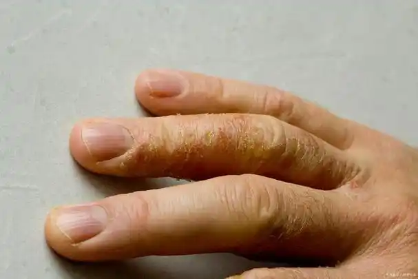 手上脱皮干燥开裂是皮肤病吗