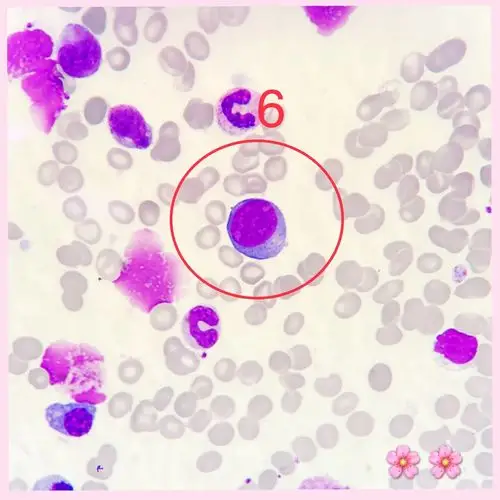 其它 基础细胞图片 写美篇答案:早幼红细胞 形态特征:胞体呈圆形或