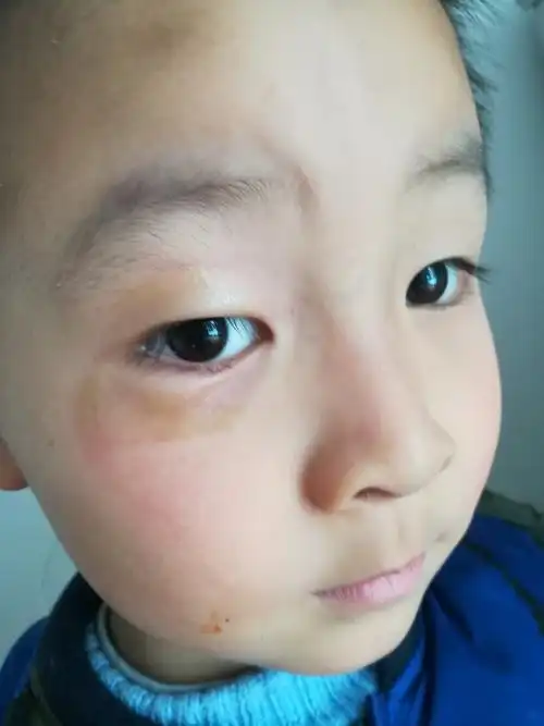 今天不知怎么?突然的两只眼皮下面肿起来了,像个鱼泡眼.