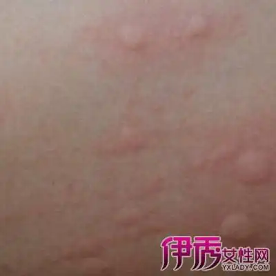 【图】艾滋病皮疹图片女大全欣赏 教你6种医治它的小妙招