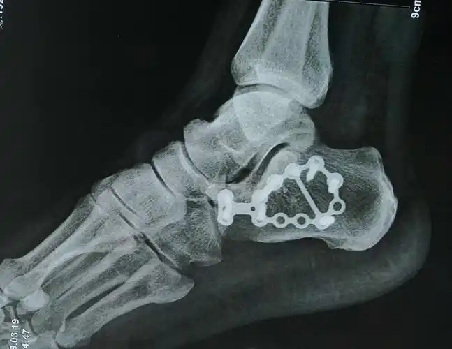 【足踝篇】 000 右侧跟骨骨折并跟距关节脱位(病例展示)