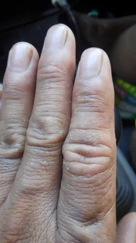 皮肤干燥【多图】_39医疗图集-39健康网