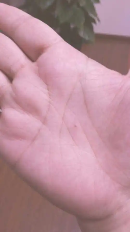 二十七岁了,手心突然长了一颗痣