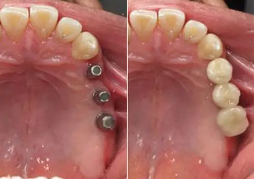 在深圳做过种植牙后的亲身经历告诉你哪家医院种牙好