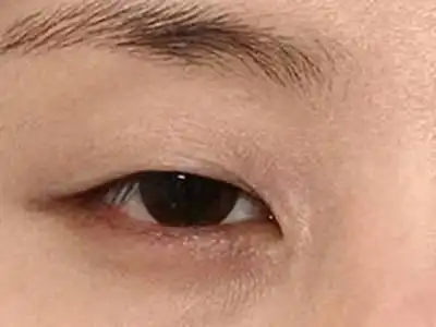 什么是眼睛重症肌无力?_手机搜狐网