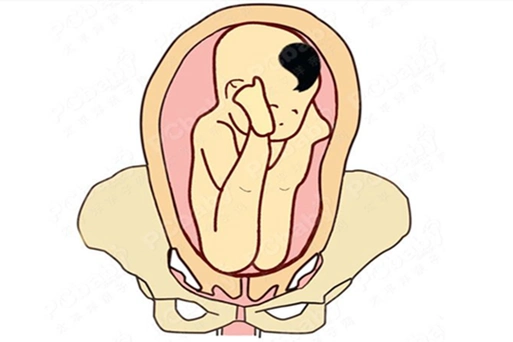 胎位臀位能顺产吗 胎臀位可以顺产吗
