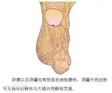 阴囊下垂怎么回事?是病吗?_昆明男健医院官网网站