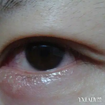 图眼睑上长了个小水泡是怎么回事其5个治疗方法介绍