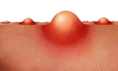 女性私处长痘痘是什么原因?盛百颜来告诉你!