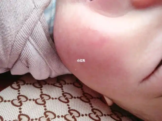 宝宝的脸湿疹很严重,还带红血丝,然后眼睛周围和额头还有那种红红的