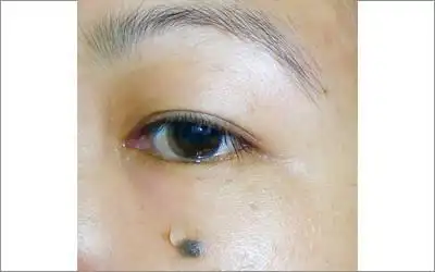 流泪痣的位置:其实流泪痣就是泪痣,是太阳穴和颧骨最高点连成直线