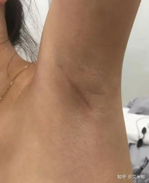 假体隆胸手术教程切口的选择篇腋下切口综述