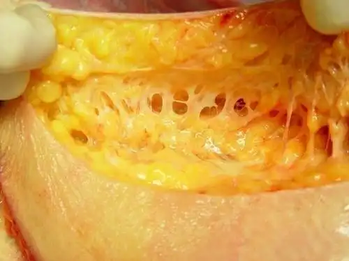 北京威塑吸脂医生推荐:玲珑体雕更适合塑形-吸脂塑形手术