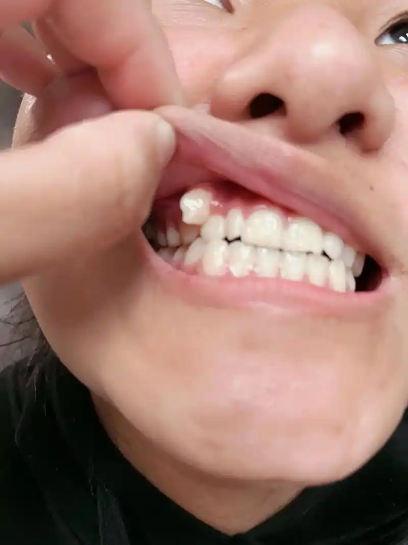 老虎牙终于拔掉了#掉牙齿的小朋友 #爱护牙齿 #掉牙的小孩 - 抖音