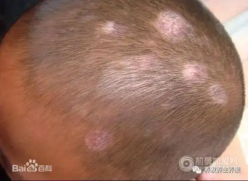 脂溢性皮炎的头皮屑防治!