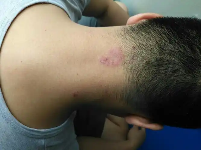 头颈部有这种事皮癣吗,怎么治?