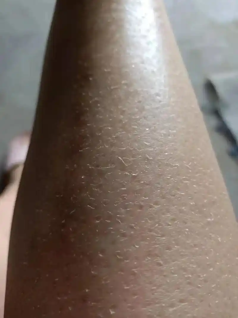 鱼鳞病#鸡皮肤鱼鳞皂#鱼鳞膏 - 抖音