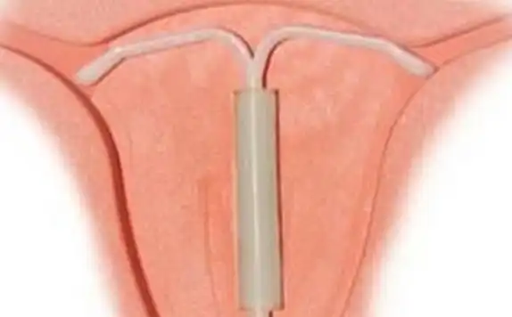 上环后出血多久算正常上环后会出血多久图