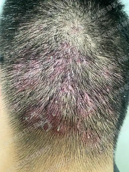 脂溢性皮炎能喝牛奶吗_上海脂溢皮炎_女性脂溢脱发能恢复吗