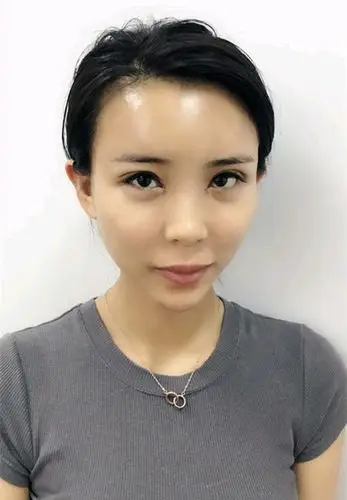 自体脂肪填充全脸