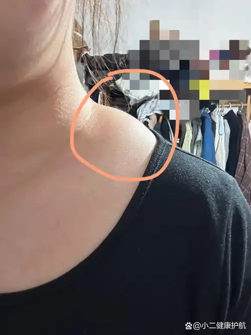 斜方肌的问题吗01 br>肩膀到脖子这块肉真的太丑了,不知道是平时