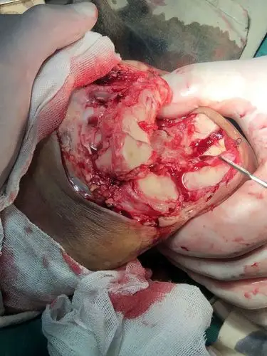 右前足离断术解除患者痛苦