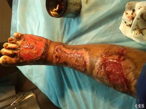 右小腿足背烫伤后深2度溃烂2月求谁有好点的办法